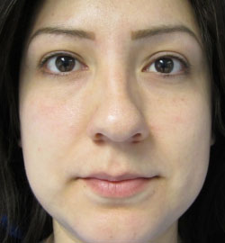 Rhinoplasty