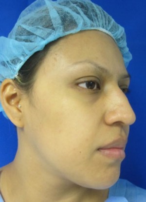 Rhinoplasty