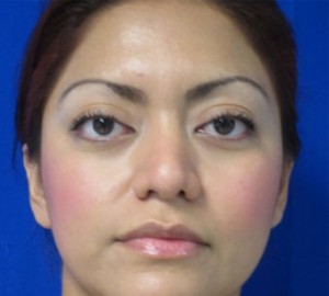 Rhinoplasty