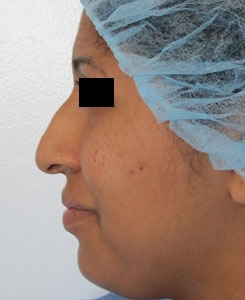 Rhinoplasty