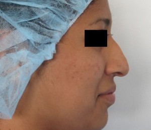 Rhinoplasty