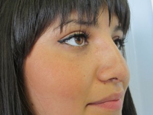 Rhinoplasty