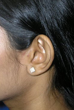 Ear Correction