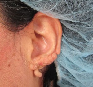Ear Correction