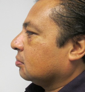 Chin Implant