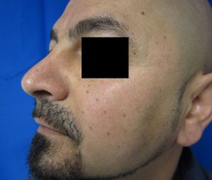 Chin Implant