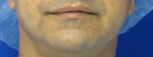 Chin Implant