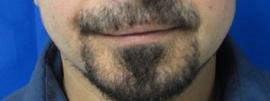 Chin Implant