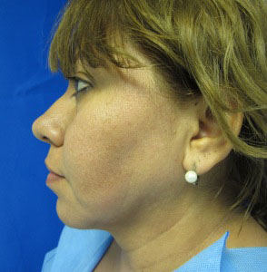 Chin Implant