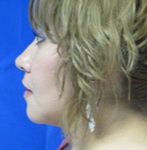 Chin Implant