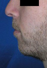 Chin Implant