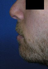 Chin Implant