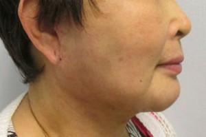Chin Implant