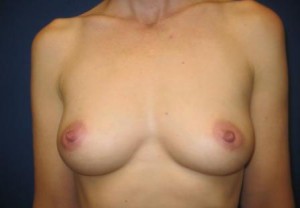 Breast Augmentation (Implants)