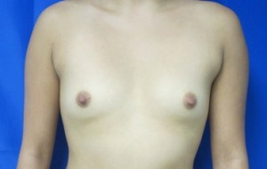 Breast Augmentation (Implants)