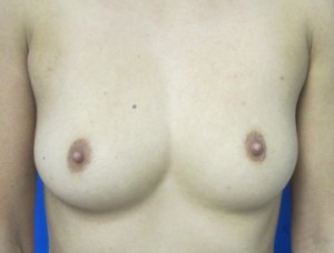 Breast Augmentation (Implants)