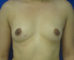 Breast Augmentation (Implants)