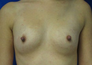 Breast Augmentation (Implants)
