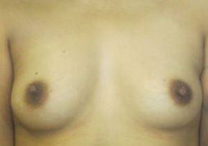 Breast Augmentation (Implants)