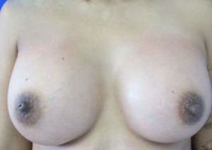 Breast Augmentation (Implants)