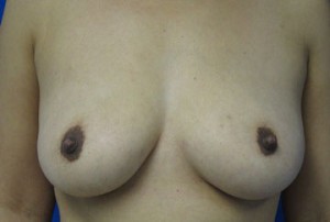 Breast Augmentation (Implants)