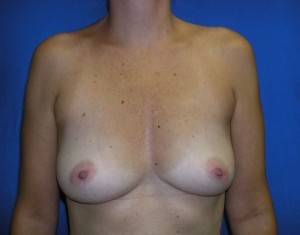 Breast Augmentation (Implants)