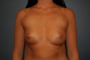Breast Augmentation (Implants)