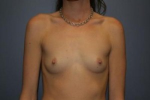 Breast Augmentation (Implants)