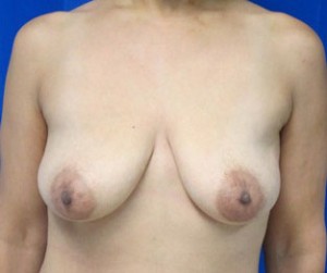 Breast Augmentation (Implants)