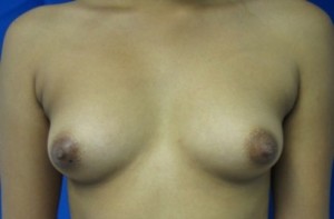 Breast Augmentation (Implants)