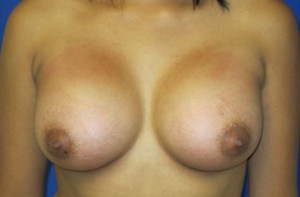 Breast Augmentation (Implants)
