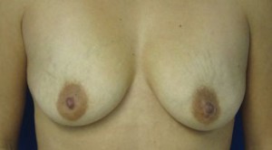 Breast Augmentation (Implants)