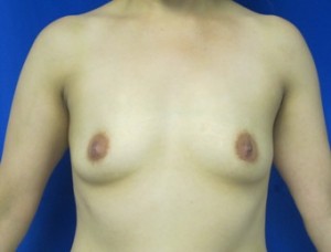 Breast Augmentation (Implants)
