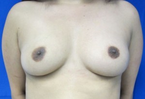 Breast Augmentation (Implants)
