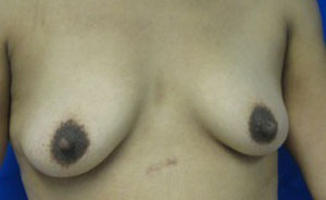 Breast Augmentation (Implants)