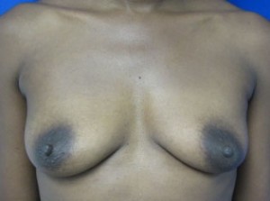 Breast Augmentation (Implants)