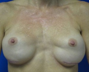 Breast Augmentation (Implants)