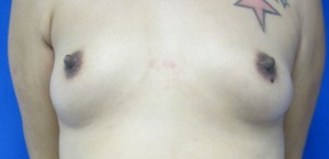 Breast Augmentation (Implants)