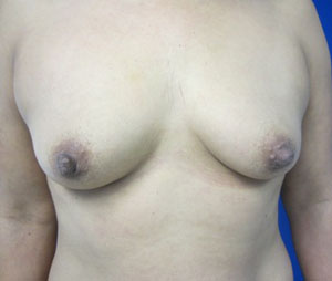 Breast Augmentation (Implants)