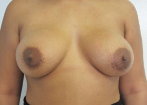 Breast Augmentation (Implants)