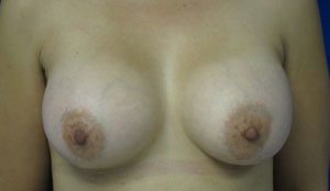 Breast Augmentation (Implants)