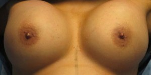 Breast Augmentation (Implants)