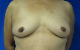 Breast Augmentation (Implants)