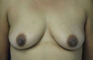 Breast Augmentation (Implants)