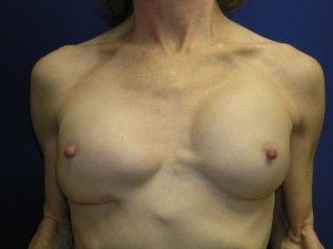 Breast Augmentation with Fat Grafting