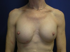 Breast Augmentation with Fat Grafting