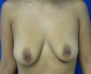 Breast Augmentation and Lift