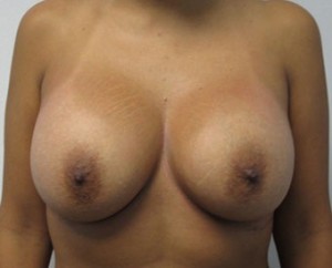 Breast Augmentation and Lift