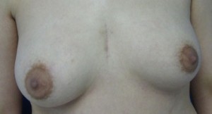 Breast Augmentation and Lift
