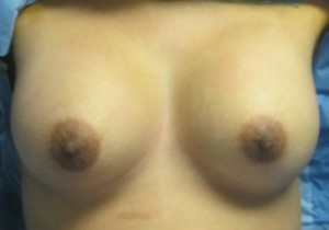 Breast Augmentation and Lift